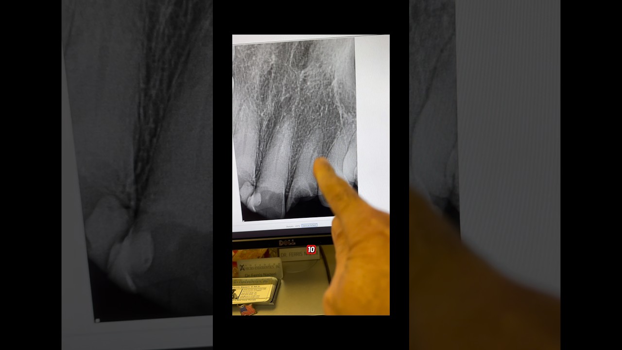 No te apresures a recomendar la extracci&oacute;n. #dentistas #arteodontol&oacute;gico #odontolog&iacute;a #tratamient...
