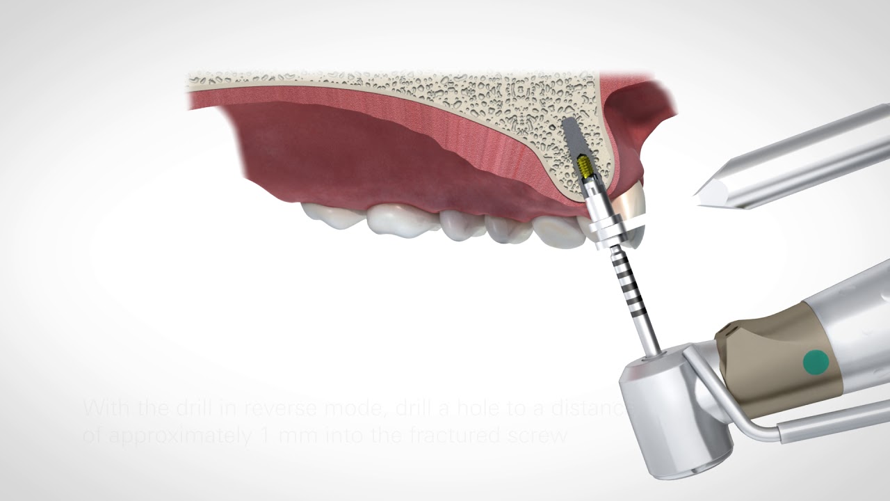 Abutment Screw Retrieval Instrument