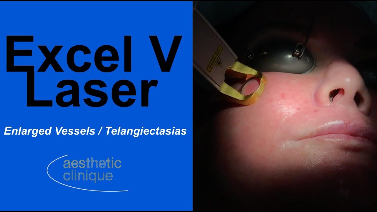 Excel V Laser treating Enlarged Vessels/Telangiectasias
