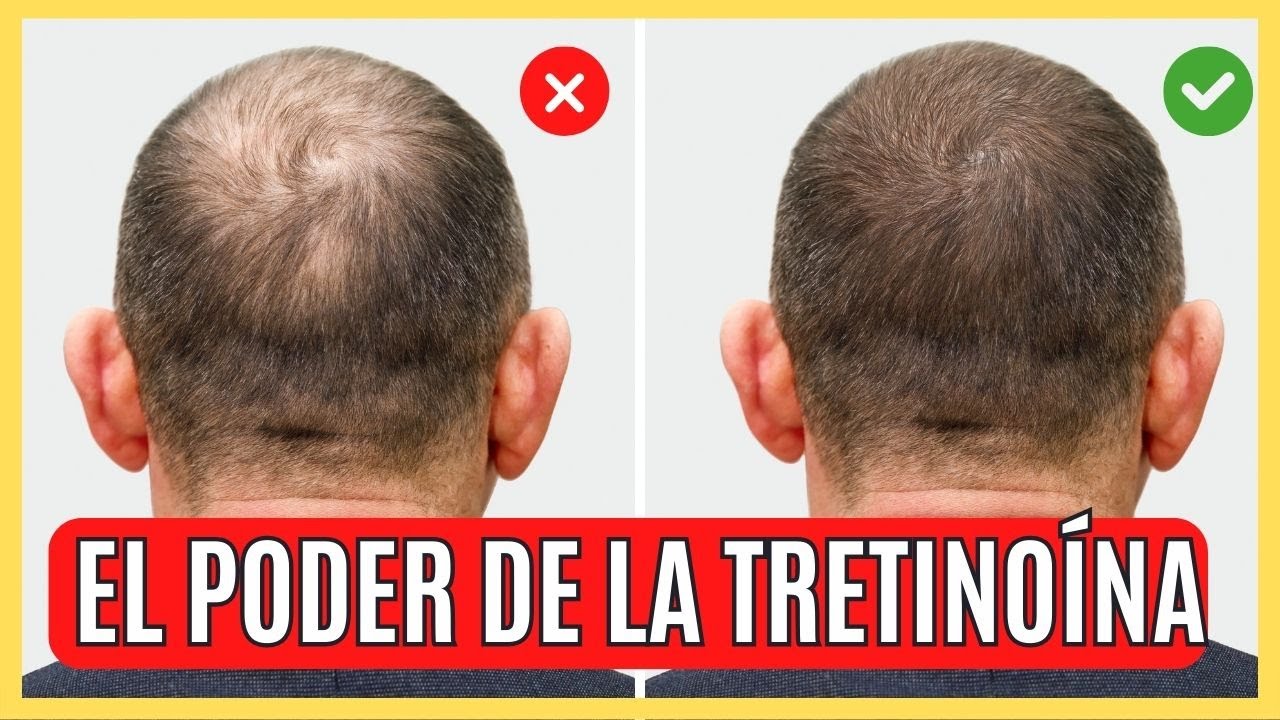 El PODER de La Tretinoína Para la ALOPECIA y la BARBA 💥