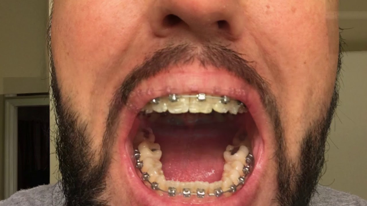 2 YEAR BRACES TIME LAPSE