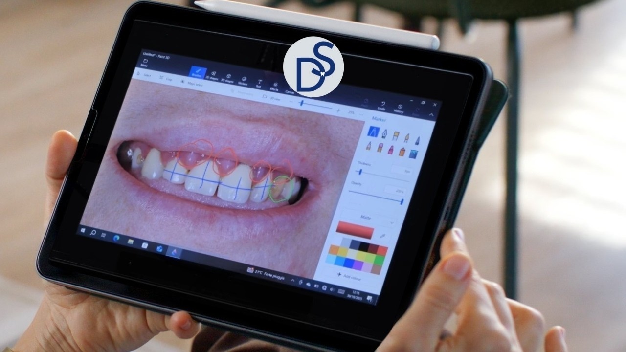 Problemi estetici e gengive infiammate: analisi del sorriso di Veronica
