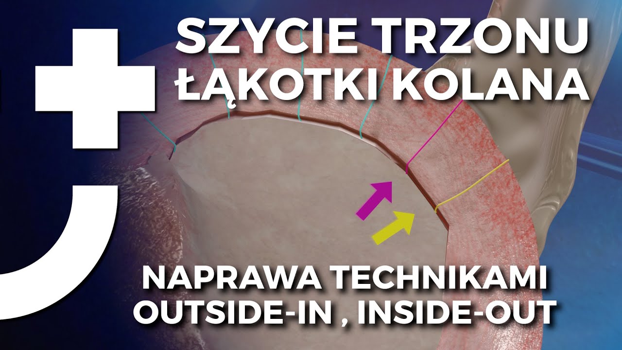 Szycie trzonu łąkotki kolana - techniki OUTSIDE-IN oraz INSIDE-OUT - animacja 3D
