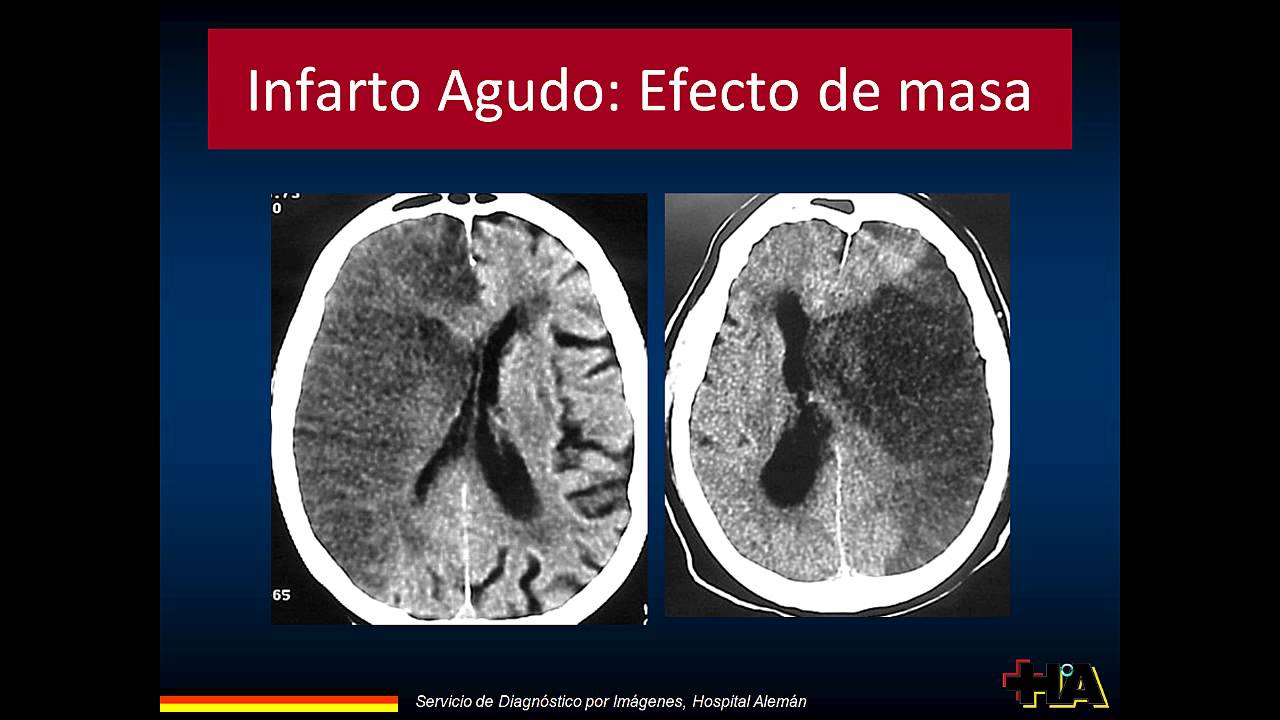 UDH SNC intro ACV deluca