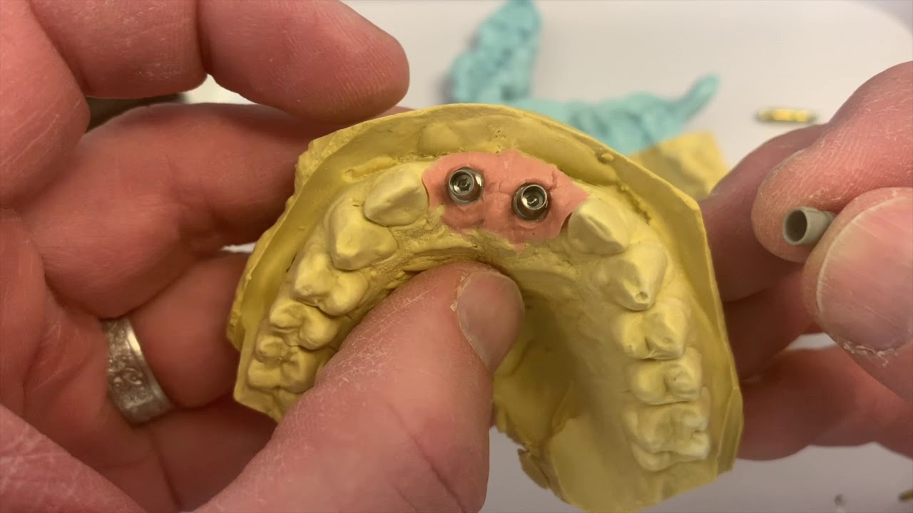 CEREC TiBase Dental Implant Crowns 8 and 9 - Whole Process!