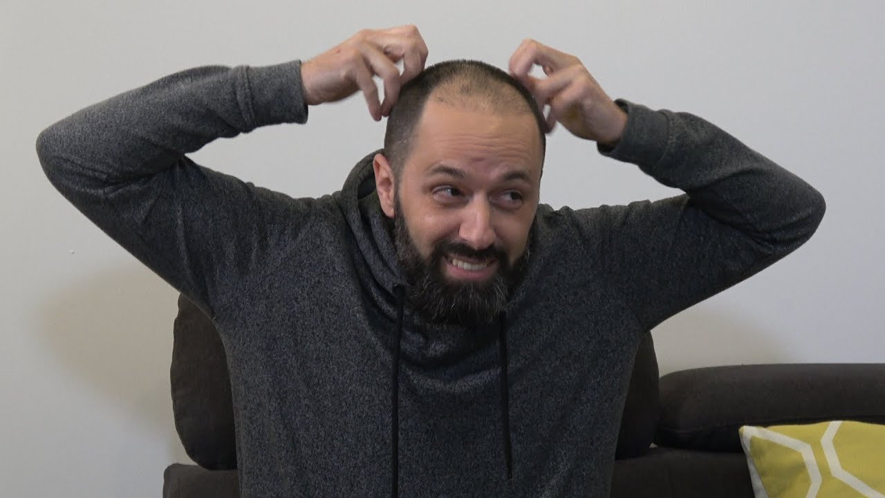 CINCO PREGUNTAS SIN CENSURA (Videopatas) El trasplante de pelo
