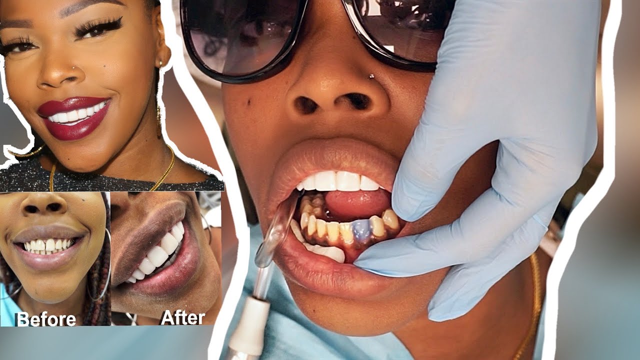 VLOG: TOOK MY SISTER TO GET HER TEETH DONE!  COMPOSITE VENEERS