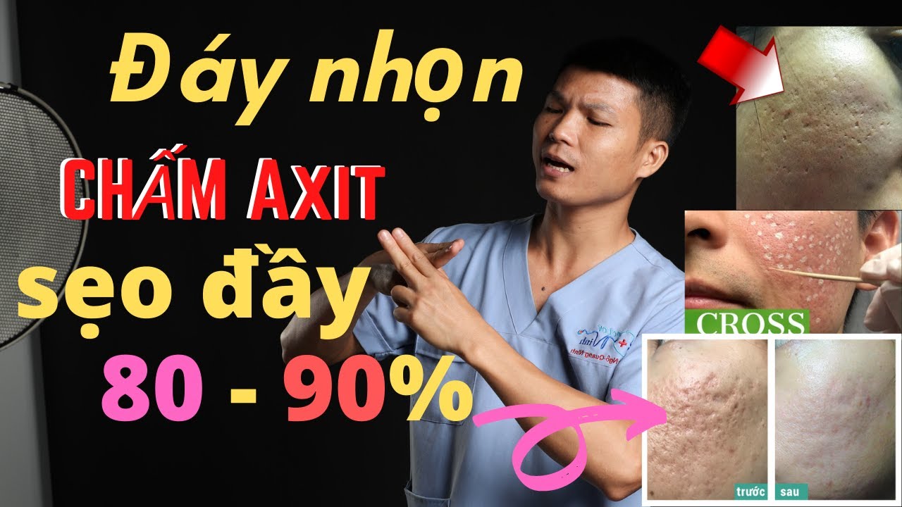 [ TCA Cross] Trị sẹo rỗ lâu năm bằng chấm Axit | 15 câu hỏi về chữa sẹo lõm đáy nhọn | Dr Ninh