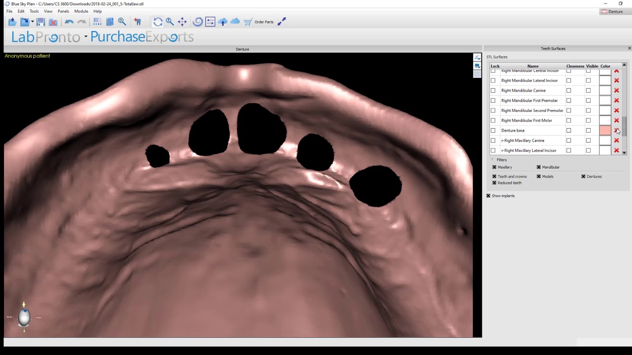 Step 5  Finalizing the Denture and Exporting the Files in Blue Sky Plan Denture Module  v 4 7 15