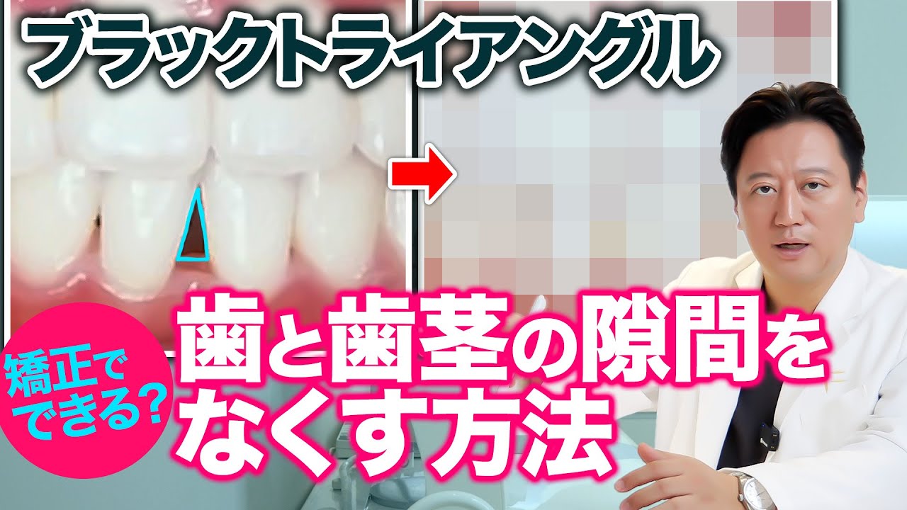 歯列矯正のデメリット！矯正治療でできるブラックトライアングルの治療方法を徹底解説します【審美歯科 歯の隙間 歯茎下がり 歯並び】