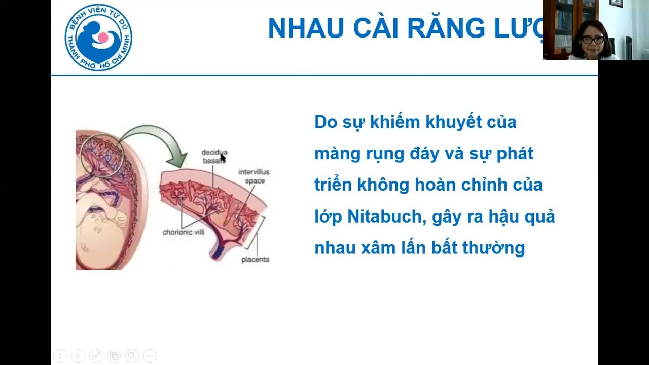 10 Vai trò của siêu âm trong chẩn đoán xuất huyết 3 tháng cuối thai kỳ - ThS.BS. Hà Tố Nguyên