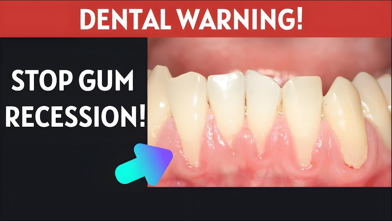 Gum Recession Warning: What Your Dentist Wishes You Knew.