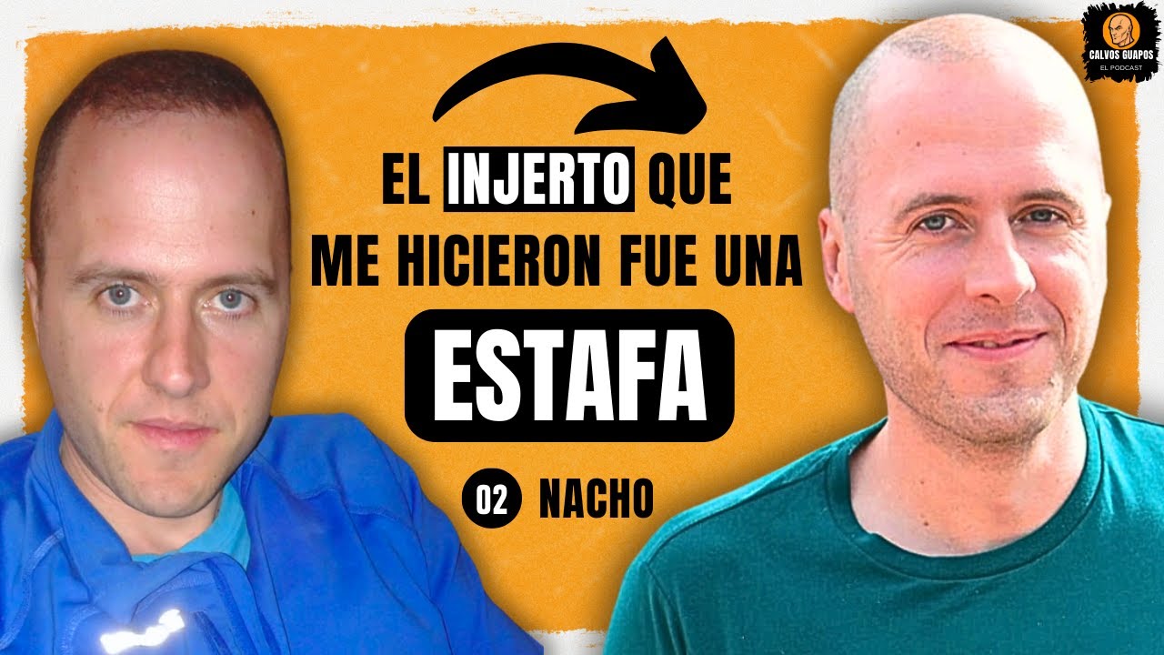 Le ESTAFAN con el INJERTO DE PELO pero lo ACEPTA y se RAPA LA CABEZA- CALVOS GUAPOS 02 - NACHO