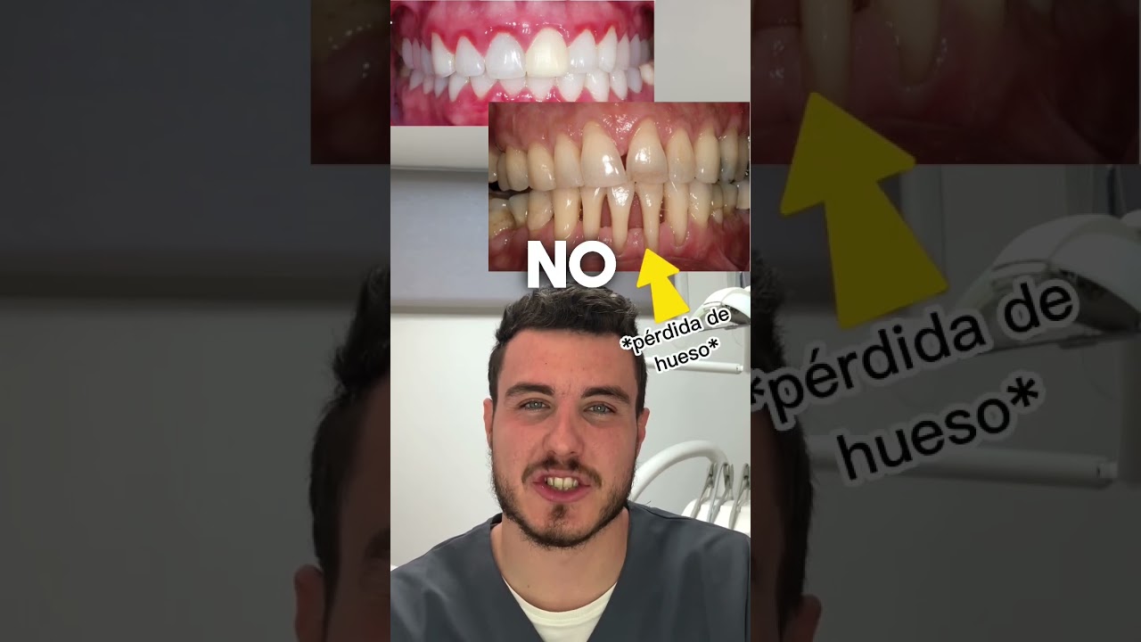 Tienes gingivitis o periodontitis? Mira esto 😱#gingivitis #periodontitis #encias #sangre #drgattoni