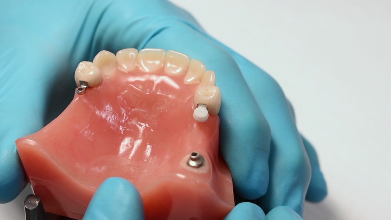 ERA® Male Attachments- The Basic Understanding of the Levels of Retention