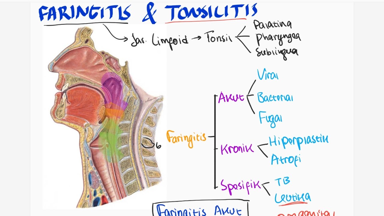 Faringitis / Radang Tenggirokan : Klasifikasi, Etiologi, Diagnosis, Tatalaksana