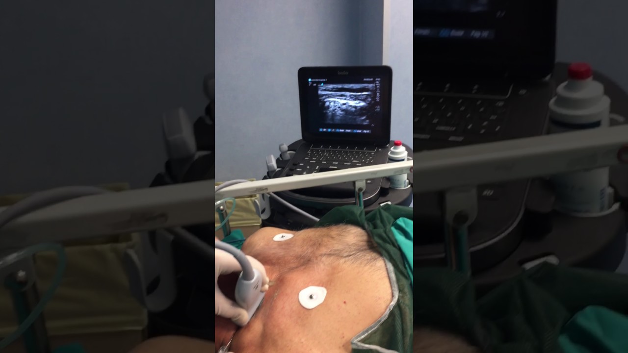Interscalenic block ultrasound