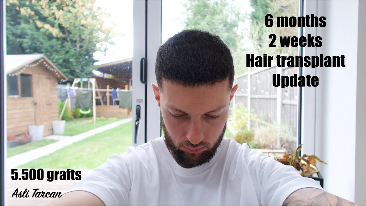 6 month Hair transplant update (Asli Tarcan)