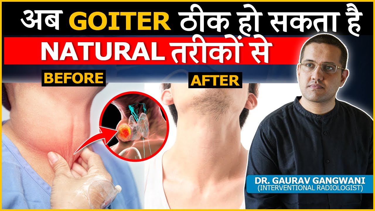 How To Cure Goiter/Thyroid Lump Without Surgery ? | Dr. Gaurav Gangwani (Interventional Radiologist)