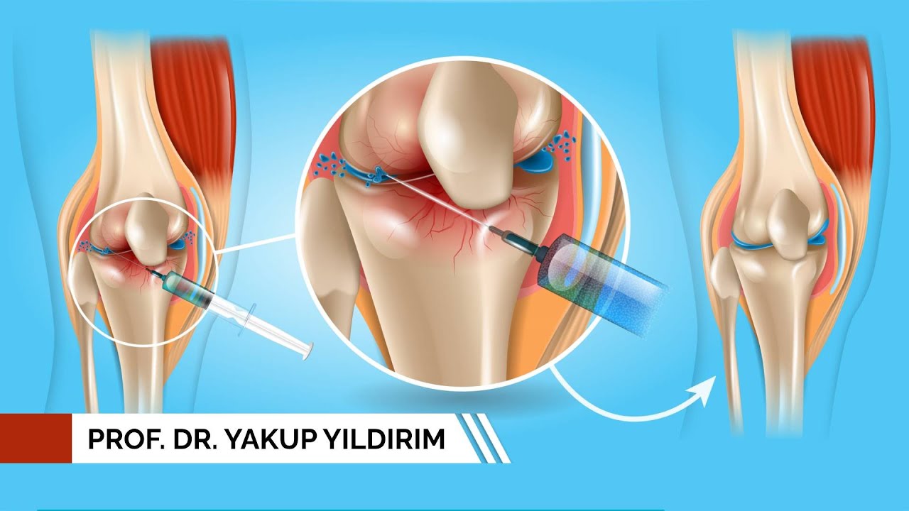 Diz İçi Eklem Enjeksiyonları | Prof. Dr. Yakup YILDIRIM