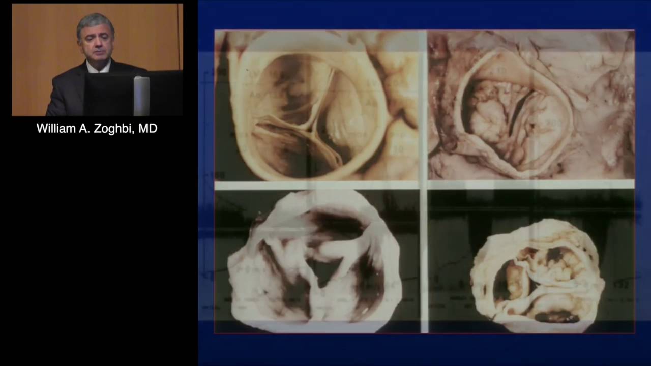 Doppler Hemodynamics: Velocity, Pressure and Flow? (William A. Zoghbi, MD) April 29, 2016