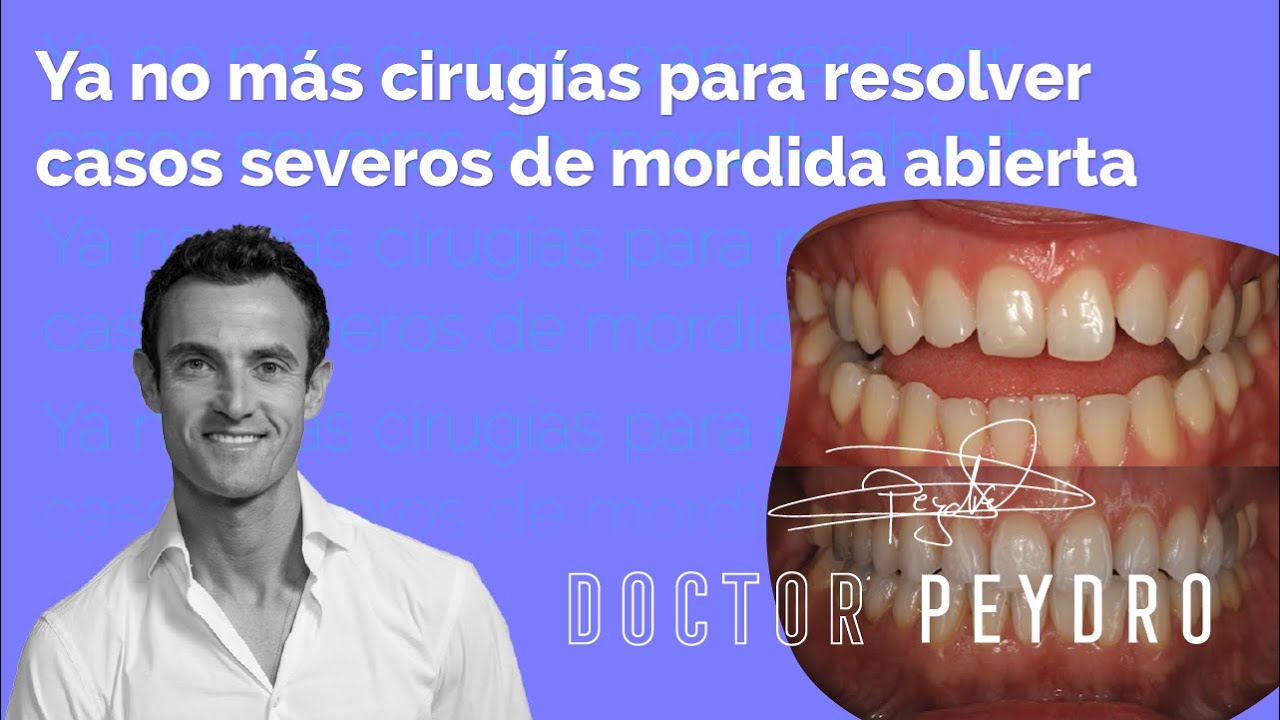 Cómo resolver MORDIDA ABIERTA SEVERA con ortodoncia invisible