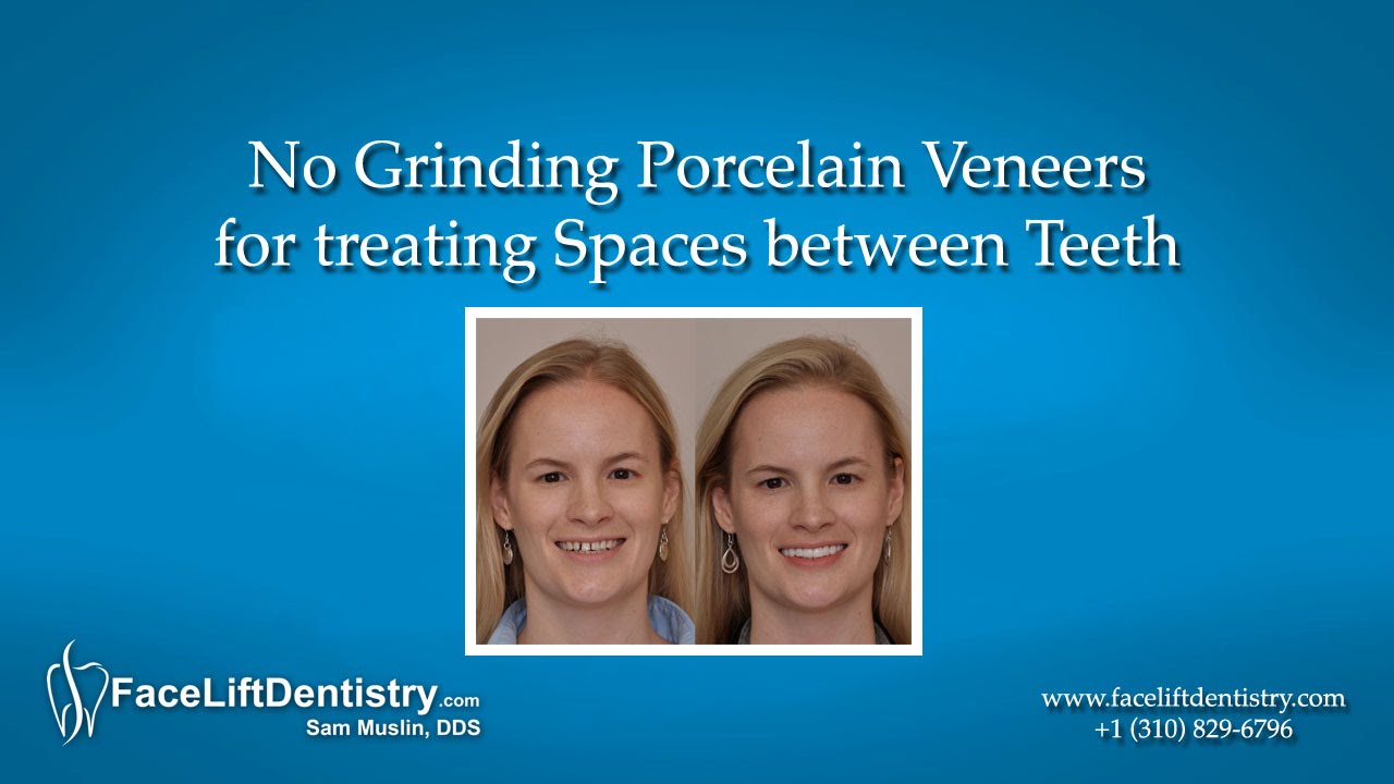No Grinding Porcelain Veneers for treating Spaces between Teeth