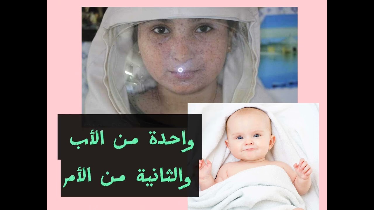 أطفال القمر🤔 مرض جفاف الجلد المصطبغ Moon children