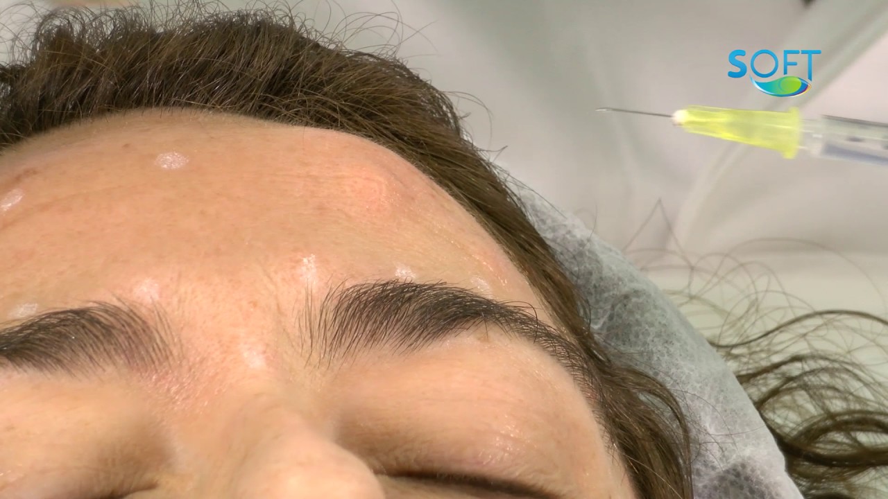Tratamiento estético con toxina botulínica (botox)