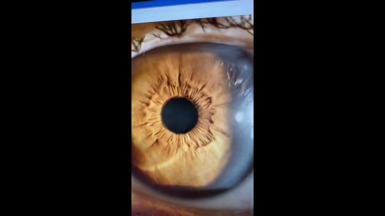 Successful PTK for advanced EKC-related cornea blindness: Kanellopoulos, MD