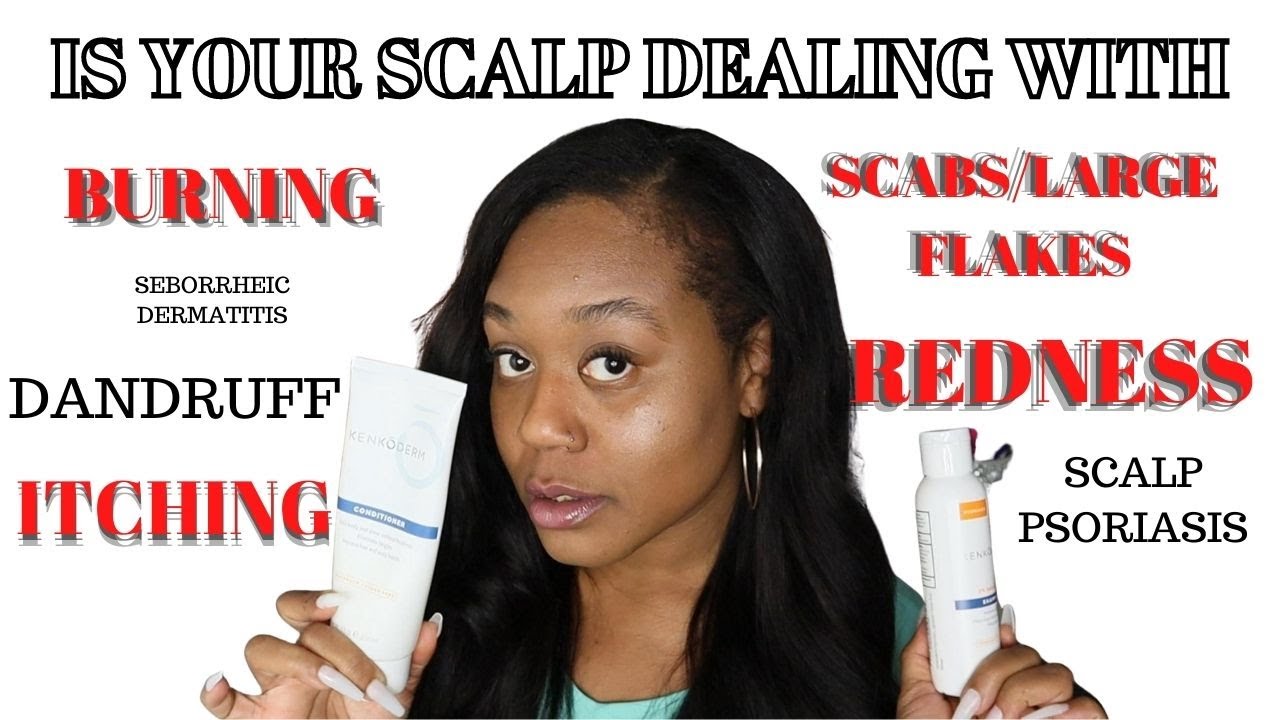 DANDRUFF BURNING, ITCHING & PAINFUL SCALP? HOW YOU FIX IT & THE CAUSE! CYN DOLL FEA. KENKODERM