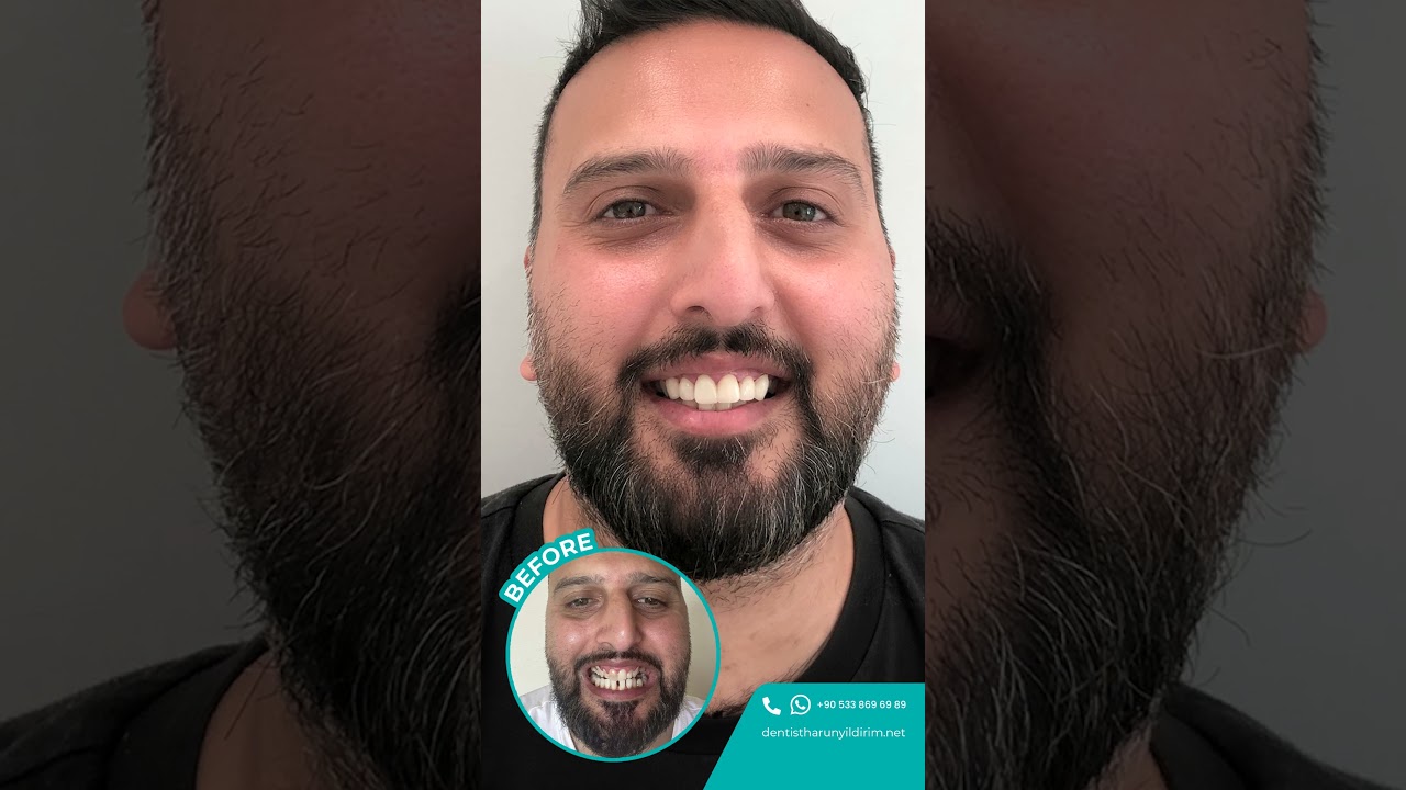 “Discover the radiance of a transformed smile with Harun Yıldırım Dental Surgery & Clinic!