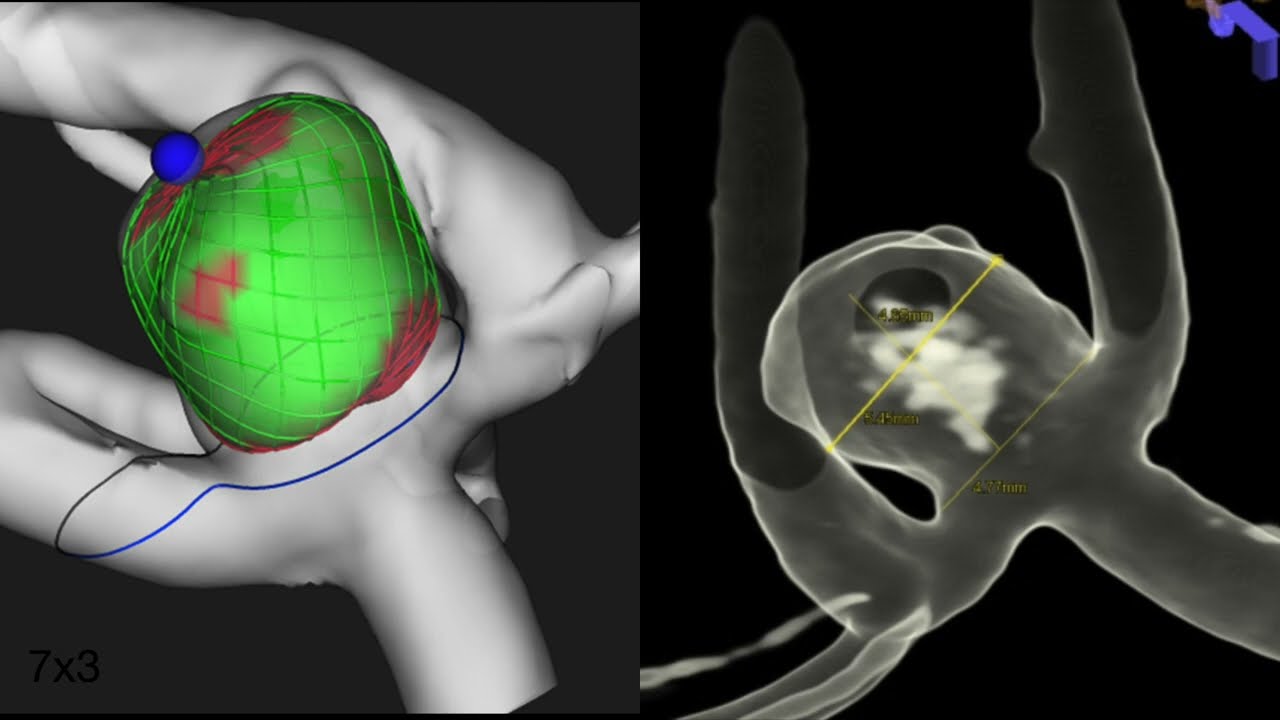 Aneurysm ACoA - Web Radial access