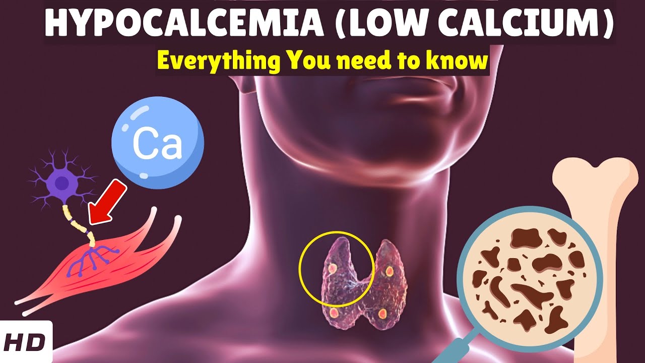 Гипокальциемия (низкий уровень кальция) – причины, признаки и симптомы, диагностика и лечение