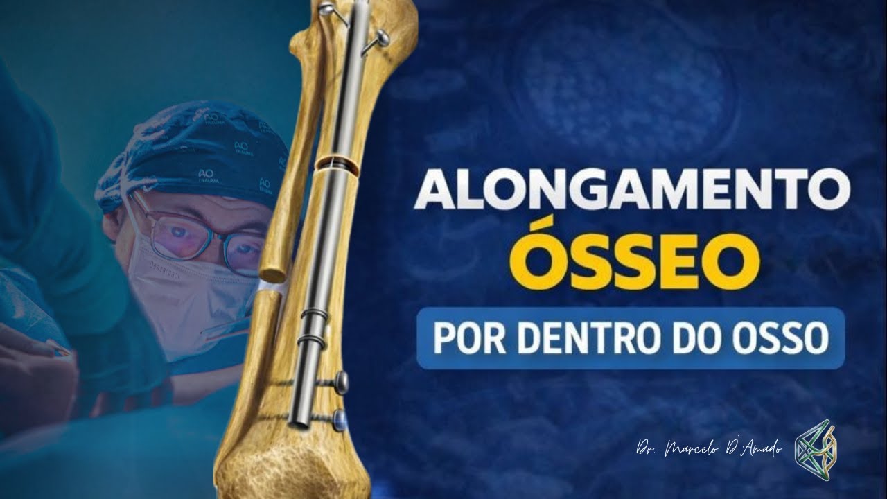 Alongamento Ósseo com Haste Motorizada: Menos Dor, Mais Conforto e Resultados Reais