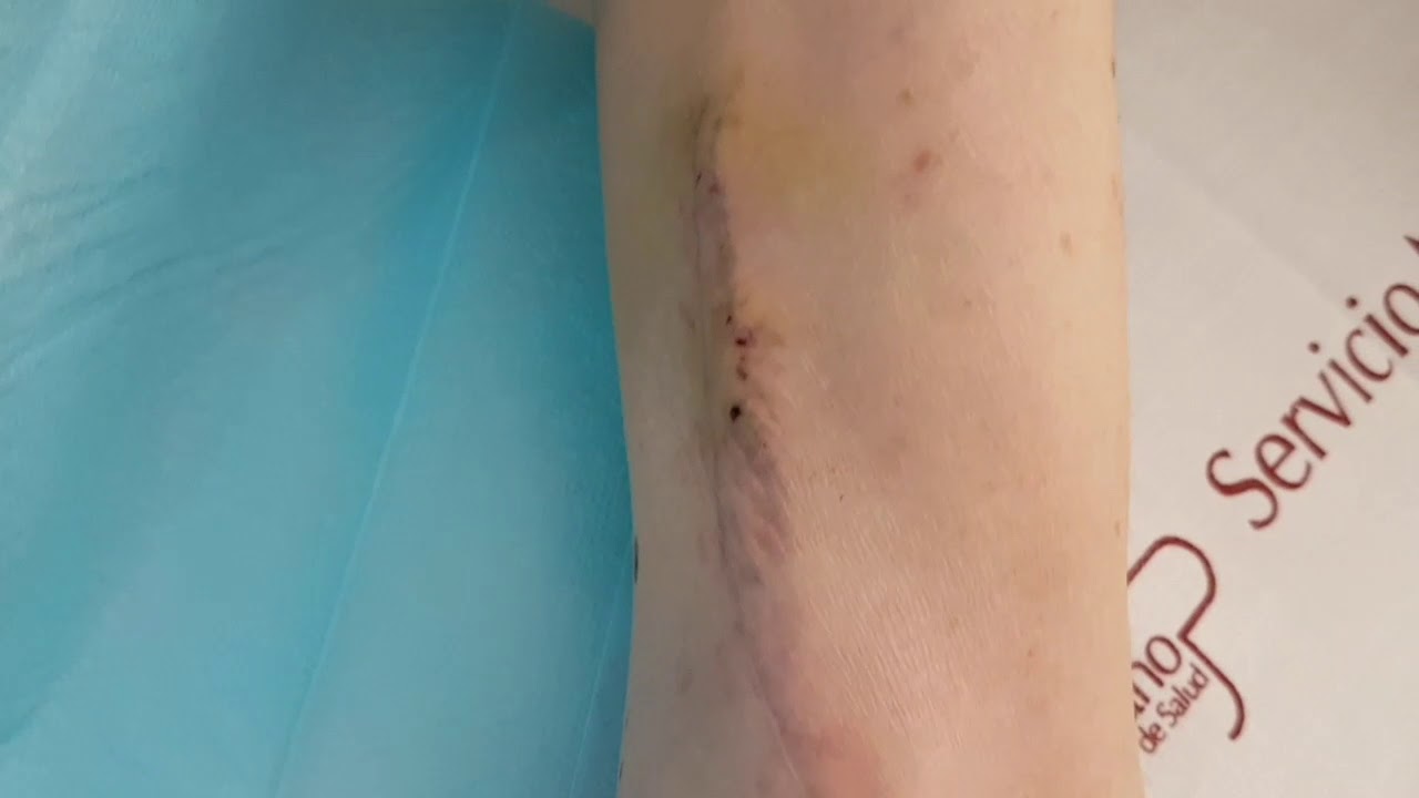 Conexi&oacute;n mixta (f&iacute;stula y cat&eacute;ter)