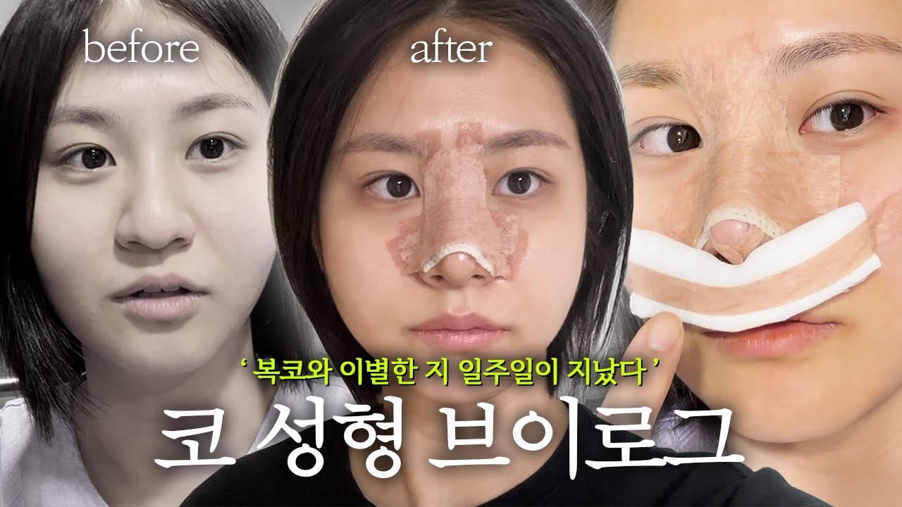 복코 성형 당일~일주일 차 200% 리얼 브이로그 🤕 | 정우성형외과 리얼 후기
