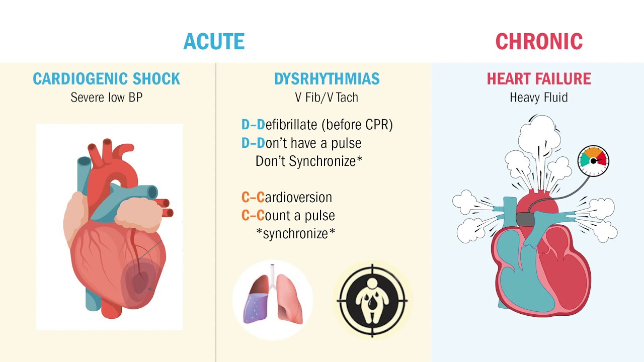 MI | Complications (Heart Failure & V Tach)