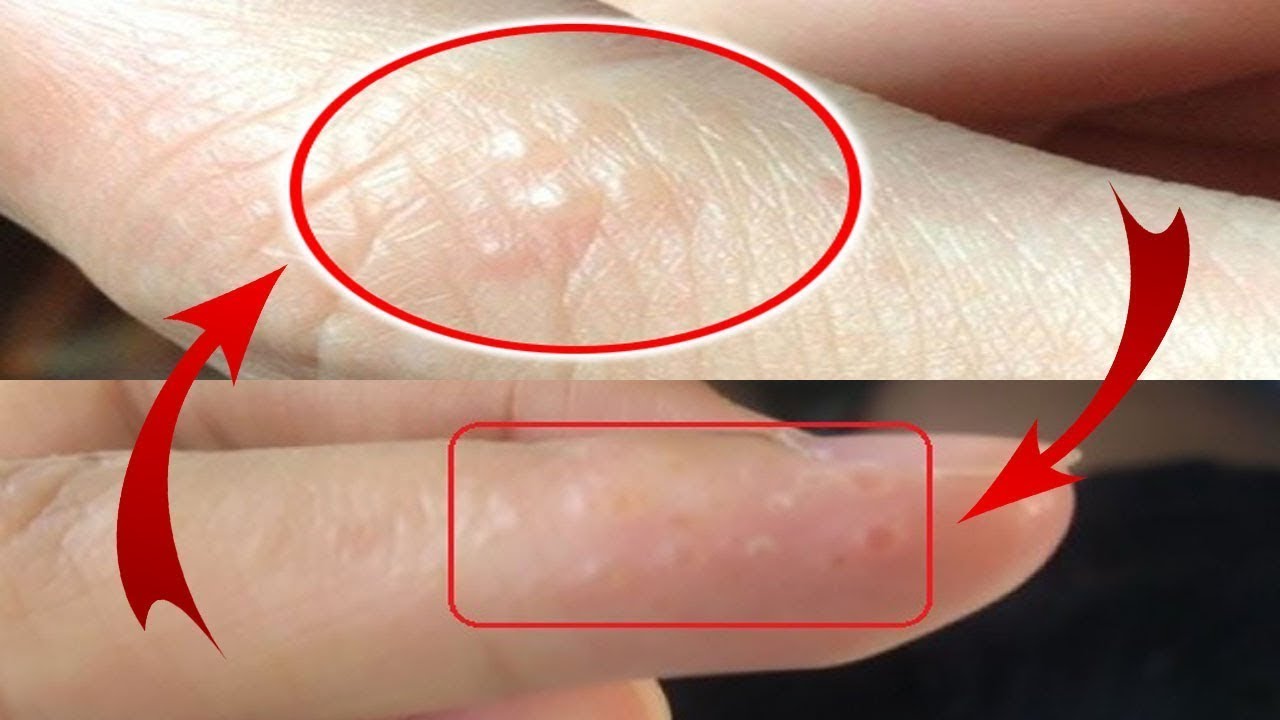 Trên tay thường xuất hiện mụn nước nhỏ, càng gãi càng ngứa, phòng tránh như thế nào