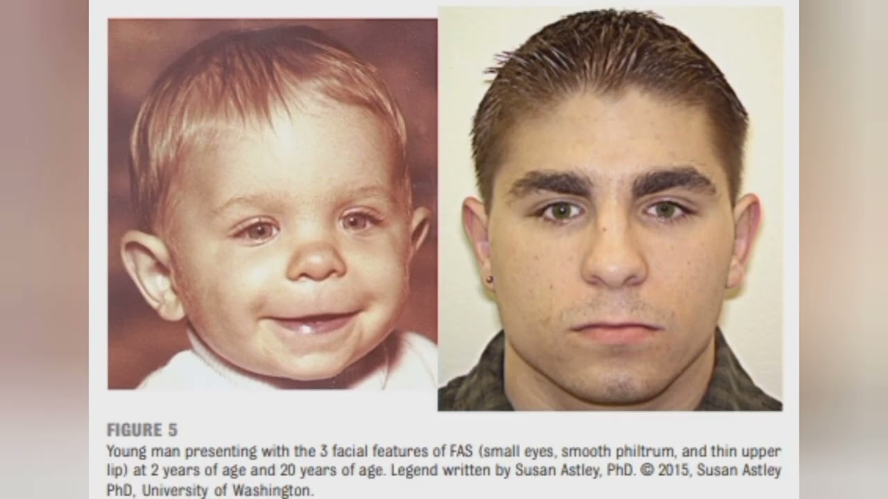 Sessão Acadêmica  - Síndrome Alcoólica Fetal