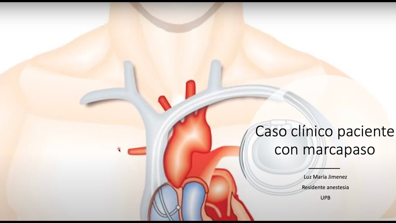 Caso Clínico: Paciente con CDI Dispositivo cardíaco para cirugía urgente