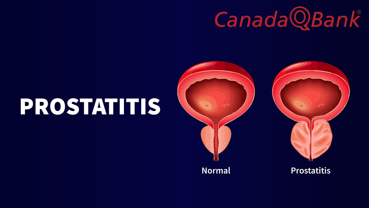 Prostatitis Explained | Types, Symptoms & Management | Urology | CanadaQBank