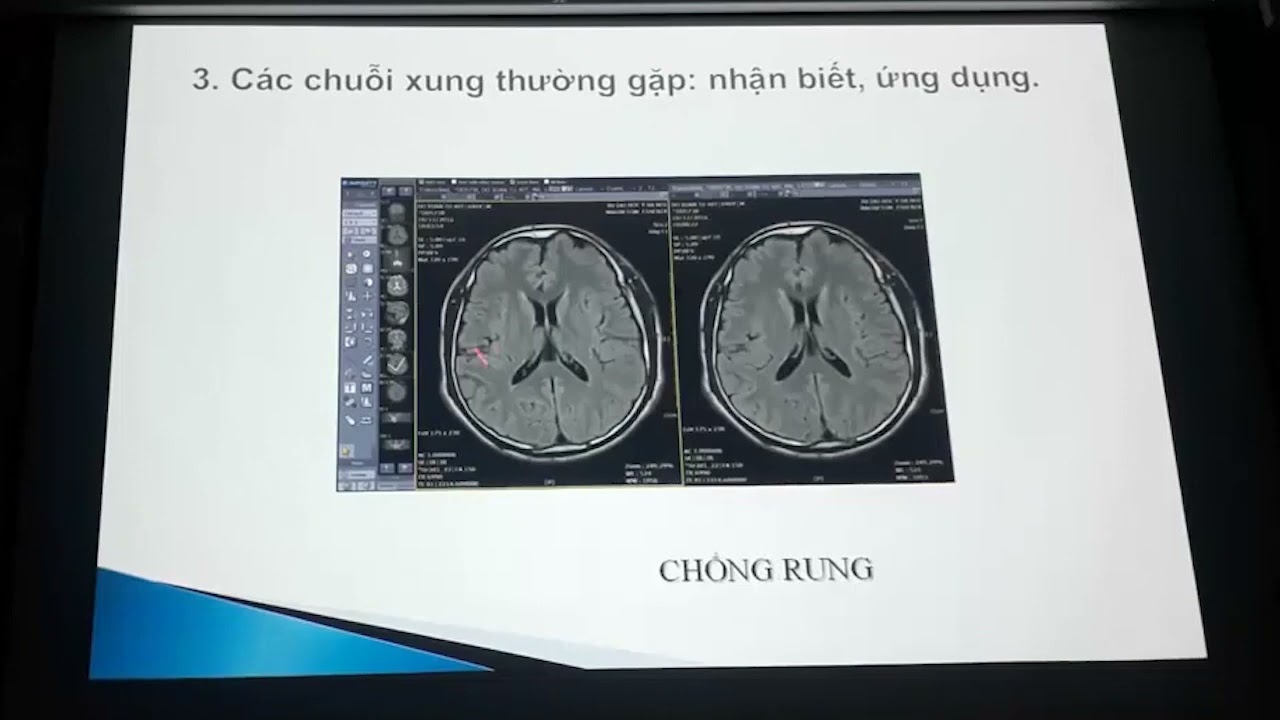 MRI: Các chuỗi xung thường gặp - nhận biết và ứng dụng - TS. BS. Lê Tuấn Linh - BV Đại học Y Hà Nội