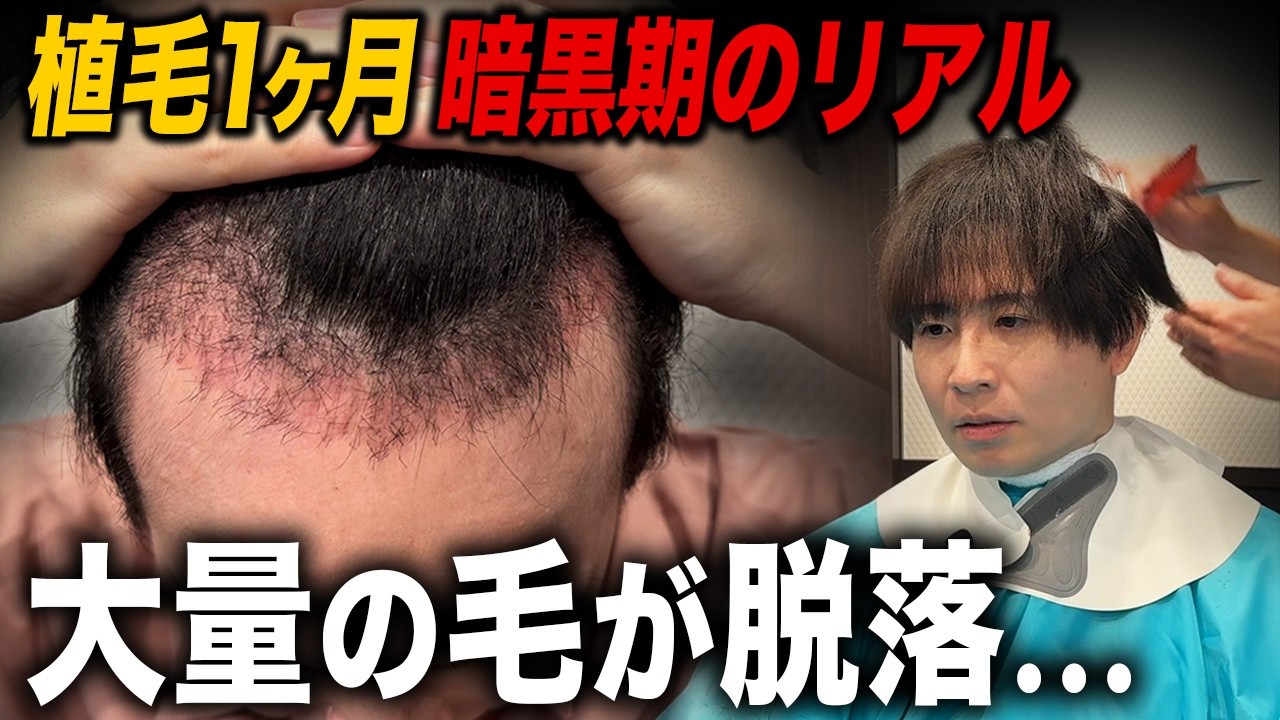 【植毛費用243万】植毛手術から1ヶ月経過した現状の状態とは？