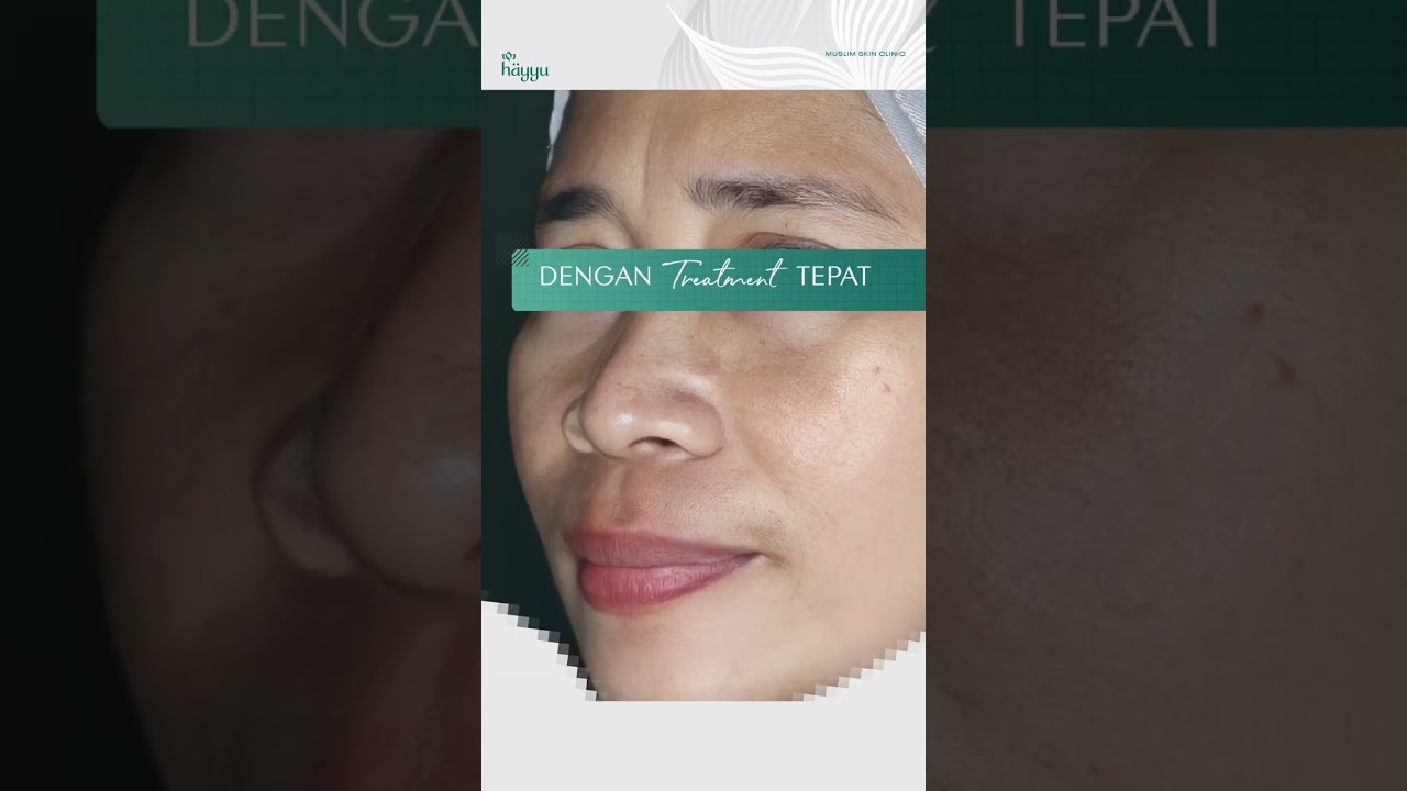 #melasma #flekhitam #pigmentation #laserflek #melasmatreatment #hayyu #shorts  #klinikkecantikan