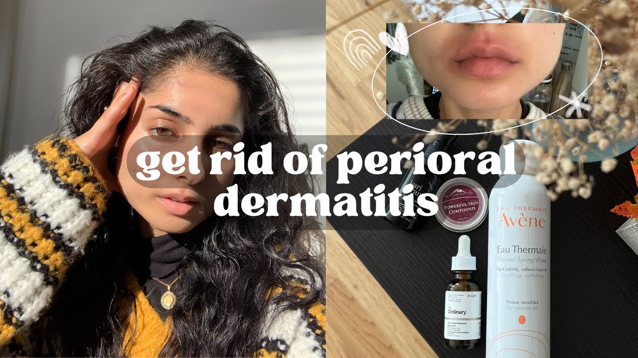 my perioral dermatitis journey - what actually worked, what didn't, natural healing and more