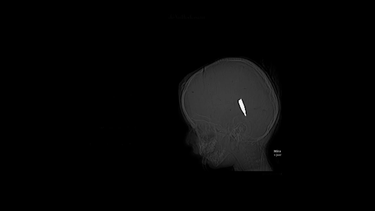 Pięć Dwa | ADHD Część 2: Gwoździe | Czarne słońca