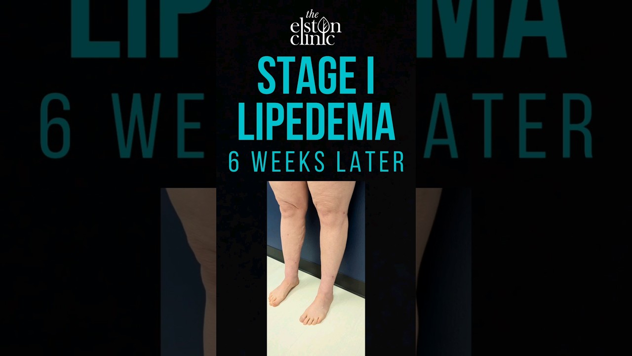 LIPOSUCTION FOR LIPEDEMA - STAGE 1 LEGS AND KNEES #lipedema