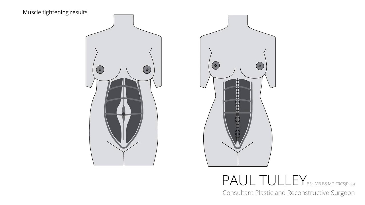 Abdominoplasty | London Tummy Tuck | Mr Paul Tulley