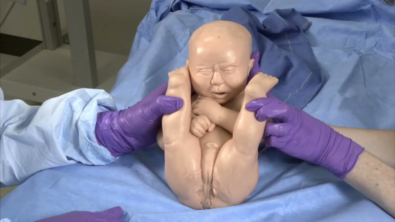 Accoucher un bébé en présentation du siège